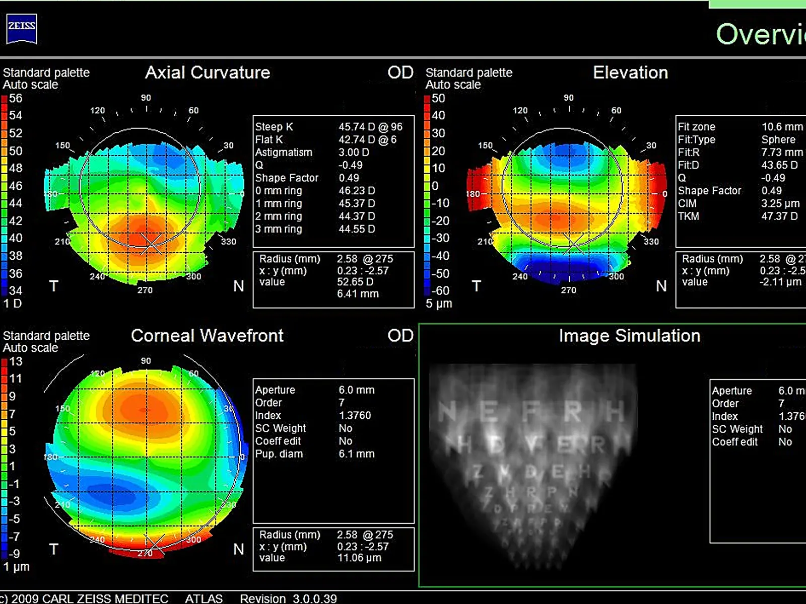Corneal topography map of a keratoconic cornea showing the steepened cone