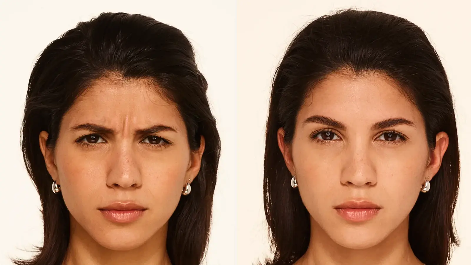 Before and after Botox results for lines of facial expression at Berg-Feinfield, Los Angeles