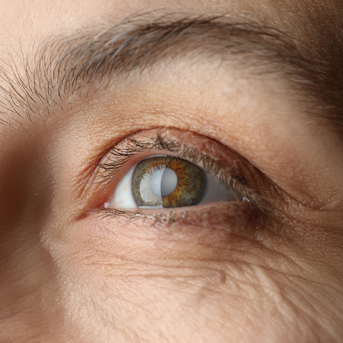 Illustration of a cataract clouding the natural lens of the eye