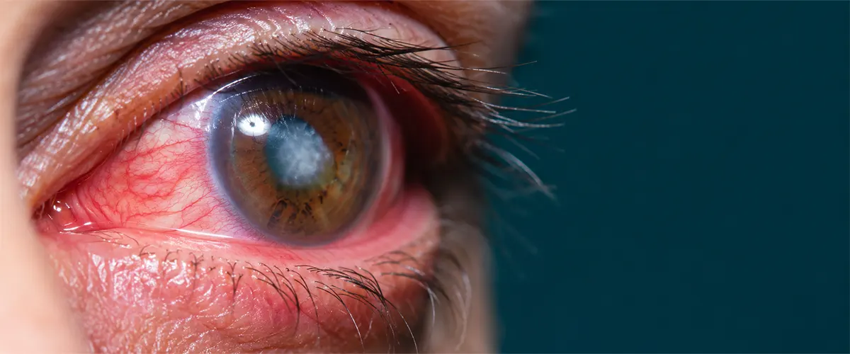 Corneal ulcer and infectious keratitis — Berg-Feinfield Los Angeles