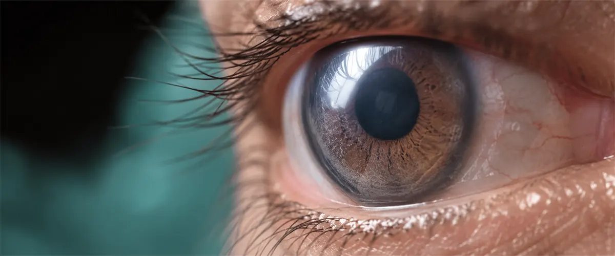 Fuchs' endothelial dystrophy — corneal cloudiness, Berg-Feinfield Los Angeles