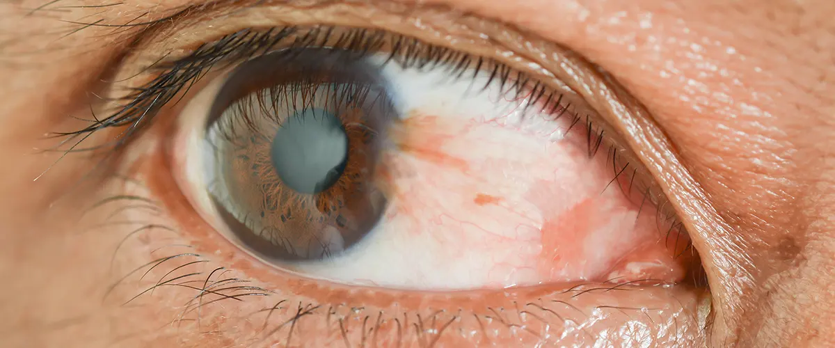 Pterygium eye condition — Berg-Feinfield Los Angeles
