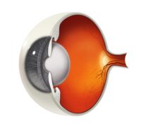 Cataract Illustration